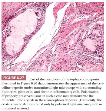 calcium pyrophosphate crystals in synovial fluid