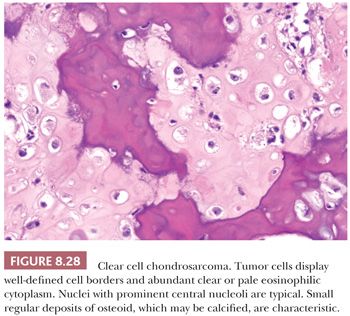 Bone Tumors | Basicmedical Key