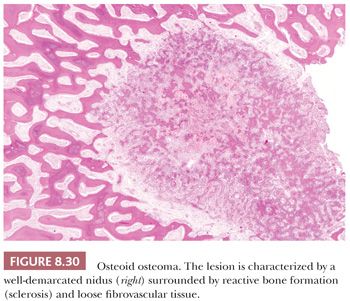 osteoid osteoma histology