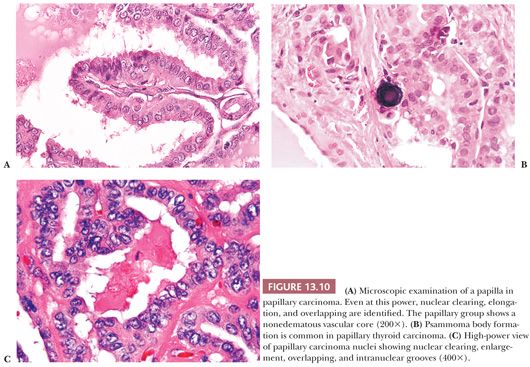 papillary thyroid cancer psammoma bodies