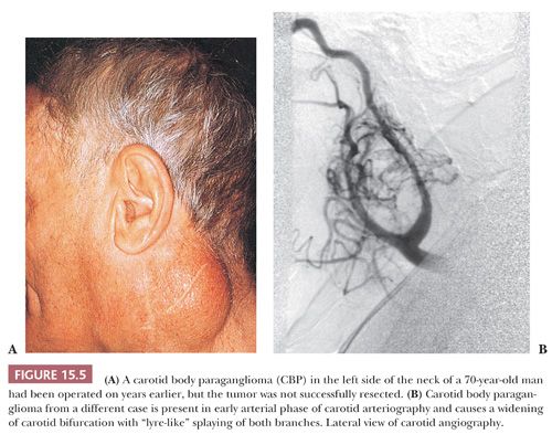 Paraganglioma: diagnoosi ja hoito