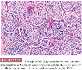 Paragangliomas | Basicmedical Key