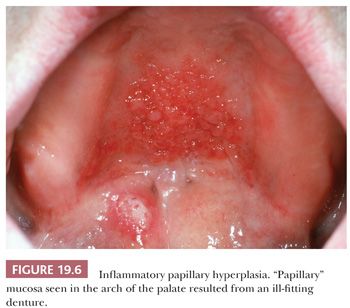 Papillomatosis in lymphedema, Papillomatosis denture