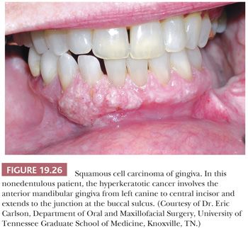 gingival papillomas