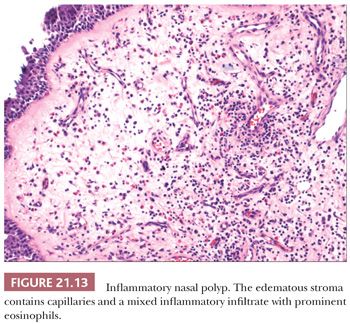 allergic nasal polyp