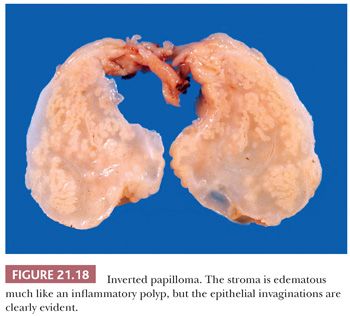 inverted papilloma gross