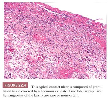 false vocal cords histology