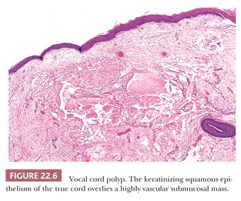 false vocal cords histology