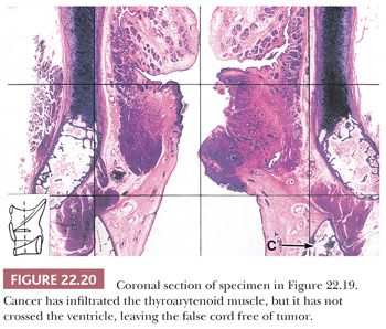 laryngeal ventricle histology