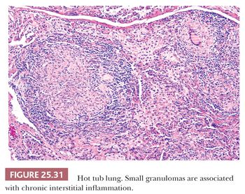 Nonneoplastic Pulmonary Disease Basicmedical Key