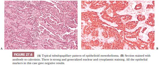 Mesothelioma Histology Tonofilaments Wild Country Fine Arts