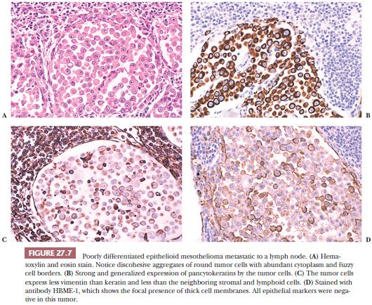 malignant pleural mesothelioma immunotherapy