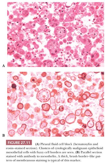 does lung cancer metastasis to the brain