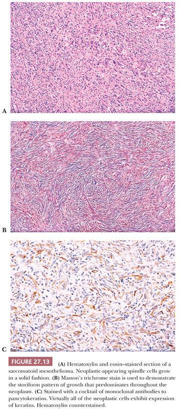 link between thyroid cancer and breast cancer