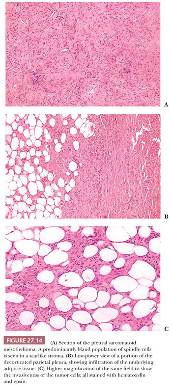 how to treat squamous cell carcinoma of the lung