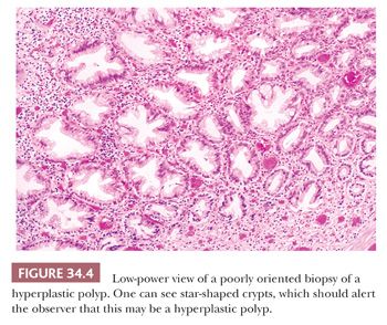 Colonic mucosa with hyperplastic changes