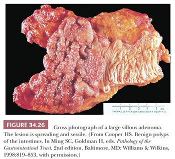 villous adenoma gross