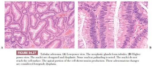 villous adenoma vs tubular adenoma