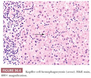 Nonneoplastic Liver Disease | Basicmedical Key