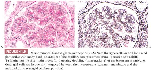 membranoproliferative glomerulonephritis tram track