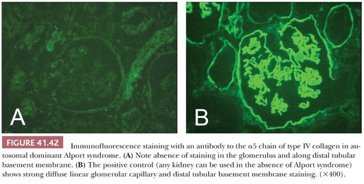 renal biopsy alport syndrome