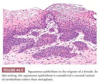 trigone bladder epithelium