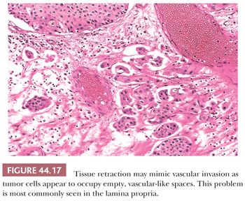 Urothelial Tract: Renal Pelvis, Ureter, Urinary Bladder ...