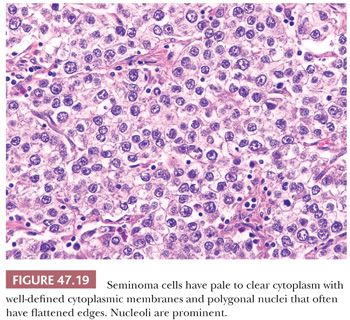 Testicular and Paratesticular Tumors | Basicmedical Key