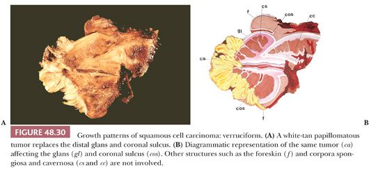 Sulcus Of Glans Penis