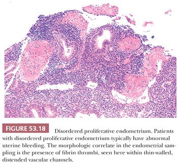 Endometrium biopsy result proliferative Disordered Proliferative