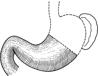 proximal vs distal stomach