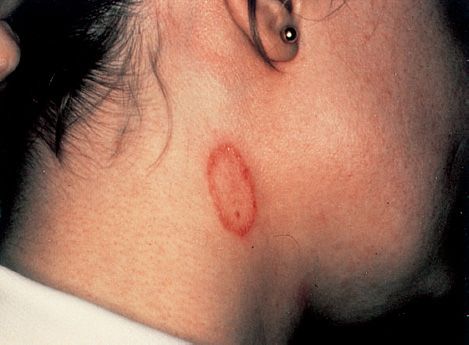 DermaCompass - Tinea corporis (mycosis)