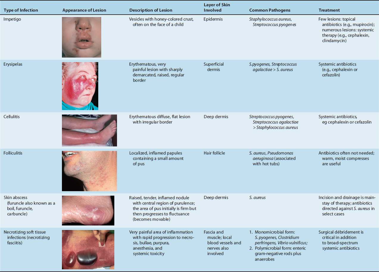 Skin And Soft Tissue Infections Basicmedical Key