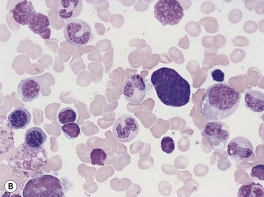 marrow bone normal megakaryocytes megakaryocyte development cells granulated grnwald giemsa stain fig