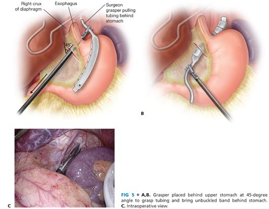 Laparoscopic Gastric Band Basicmedical Key 