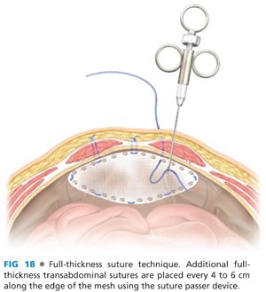 Laparoscopic Mesh Hiatal Hernia Repair | Basicmedical Key