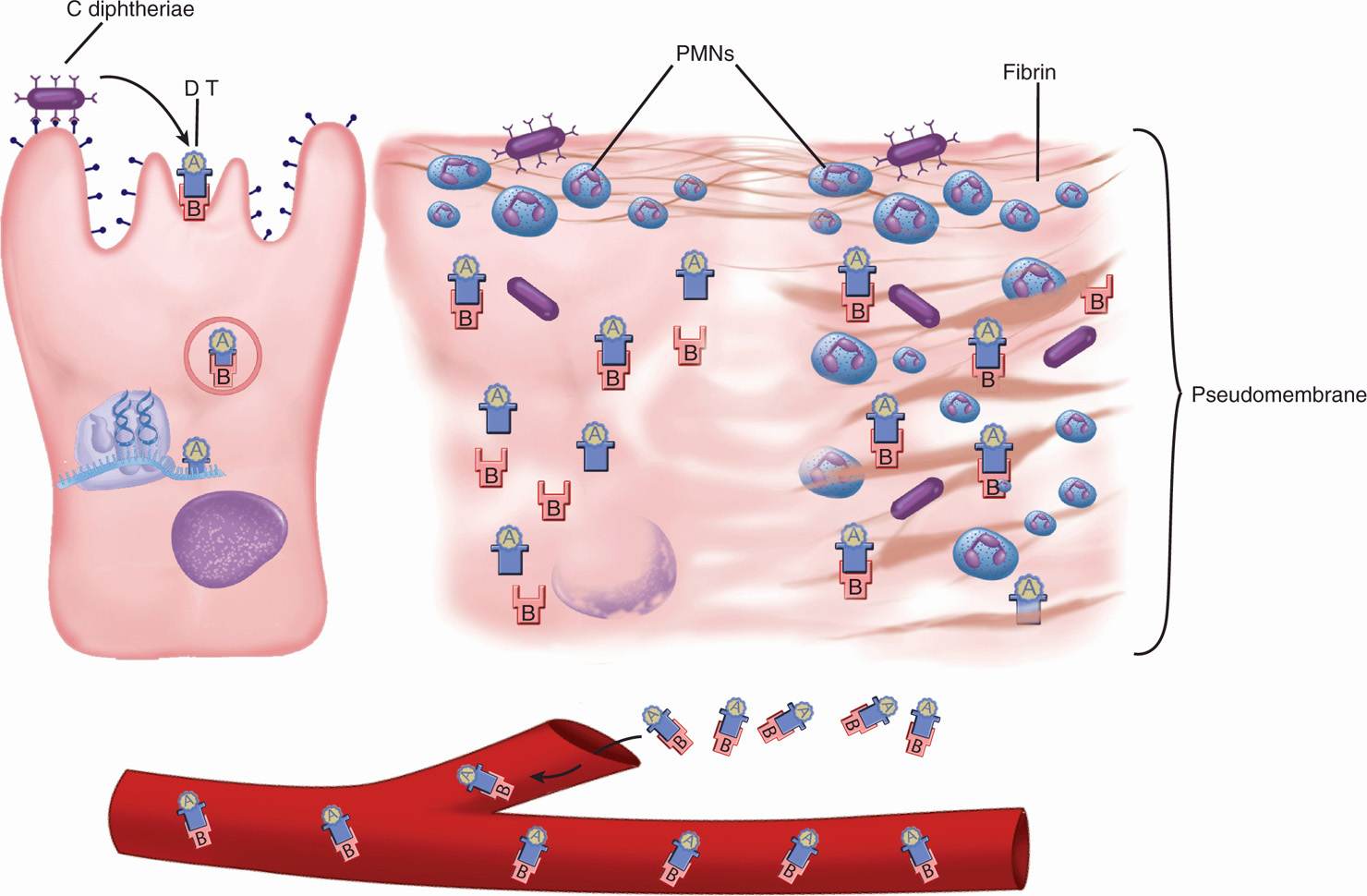 diphtheria pseudomembrane