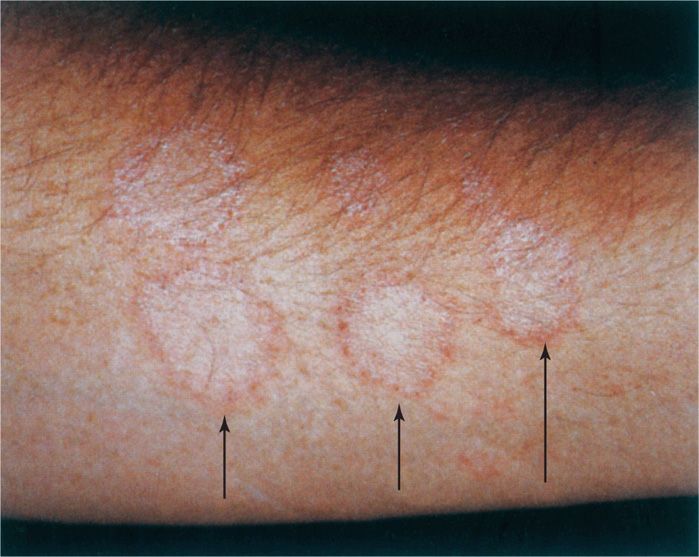 45 Dermatophytes, Sporothrix, and Other Superficial and Subcutaneous ...