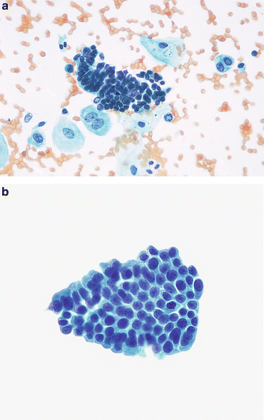 negative-for-high-grade-urothelial-carcinoma-negative-basicmedical-key