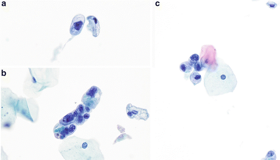 atypical-urothelial-cells-auc-basicmedical-key