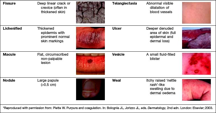 Dermatology Terminology Of Skin Lesions 3076