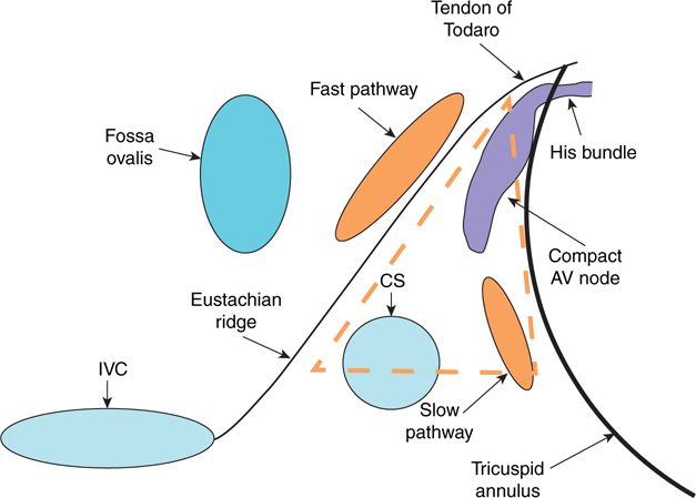 AV Nodal Reentrant Tachycardia: Atypical | Basicmedical Key