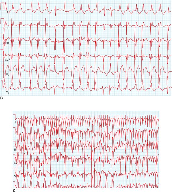 Mapping And Ablation Of Ventricular Tachycardia: Voltage Mapping ...