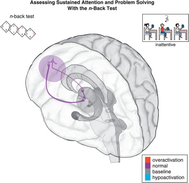 attention deficit hyperactivity disorder brain