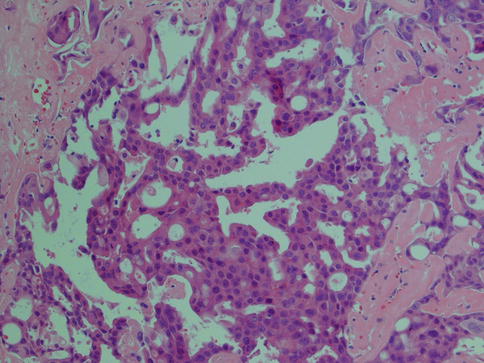 Salivary Duct Carcinoma | Basicmedical Key