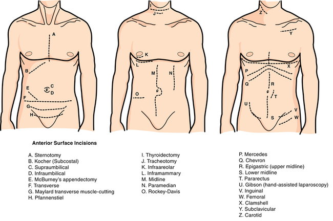 left subcostal incision