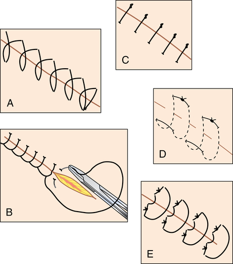 Simple Continuous Suture Pattern