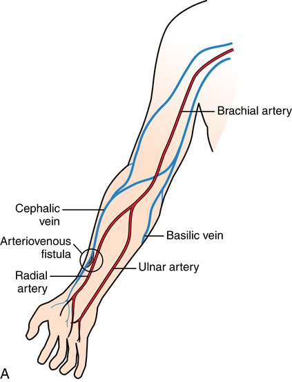 Urologic Surgery Basicmedical Key