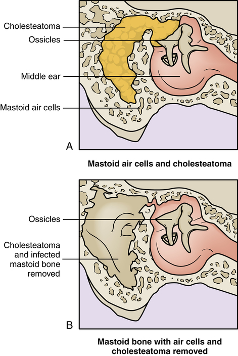 mastoid air cells