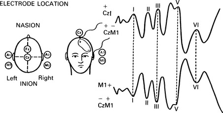 auditory brainstem response